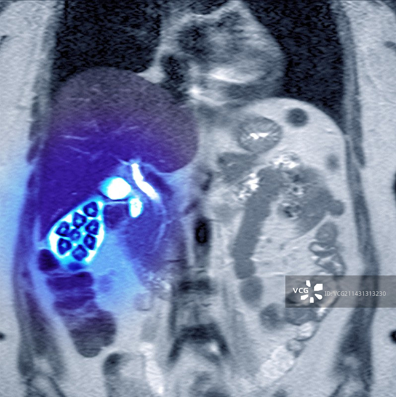 胆结石图片素材