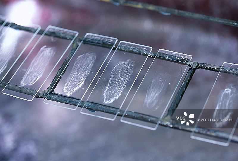 肺结核诊断图片素材