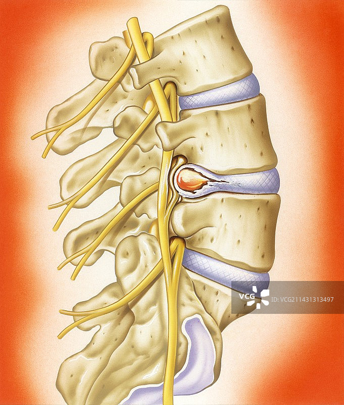椎间盘突出插图图片素材