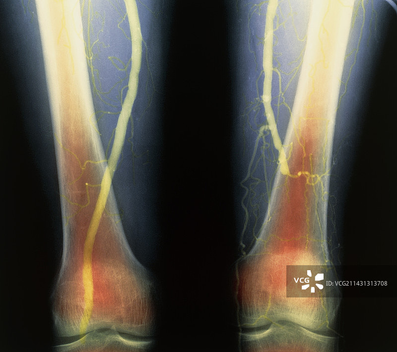 血管阻塞血管造影图图片素材