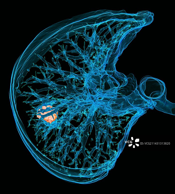 肺癌3D CT扫描图片素材
