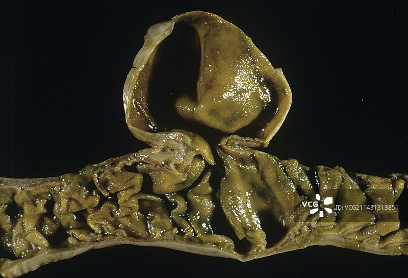 肠道梅克尔憩室图片素材