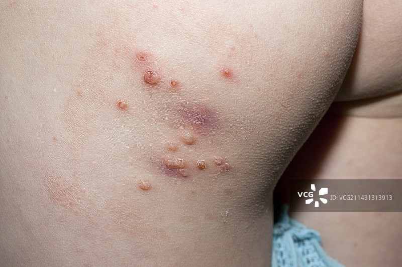 传染性软疣感染图片素材