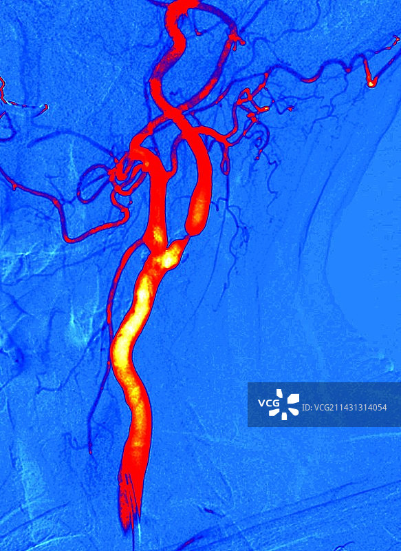 颈动脉狭窄数字血管造影图片素材