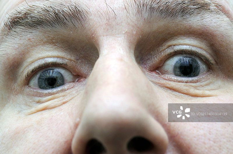 霍姆斯-阿迪综合征中的瞳孔放大图片素材