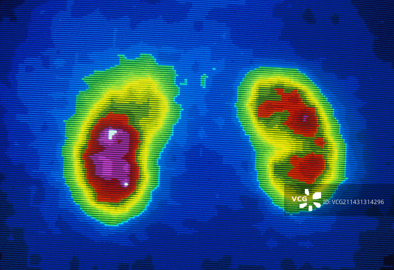 右肾衰竭的伽马扫描图片素材