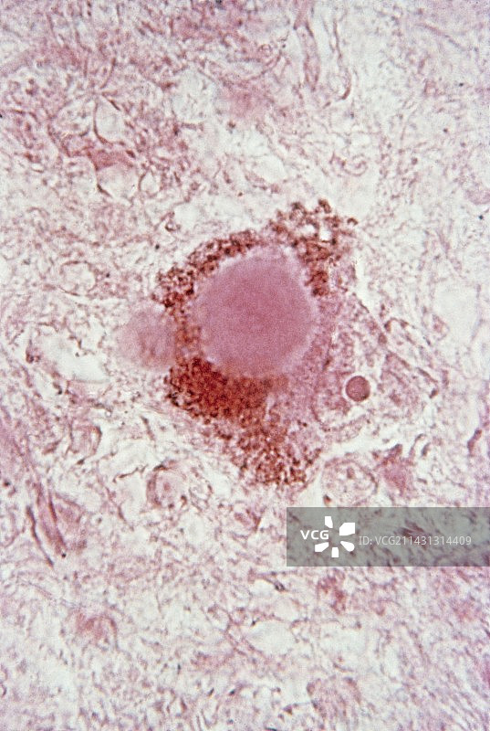 帕金森病显微照片图片素材