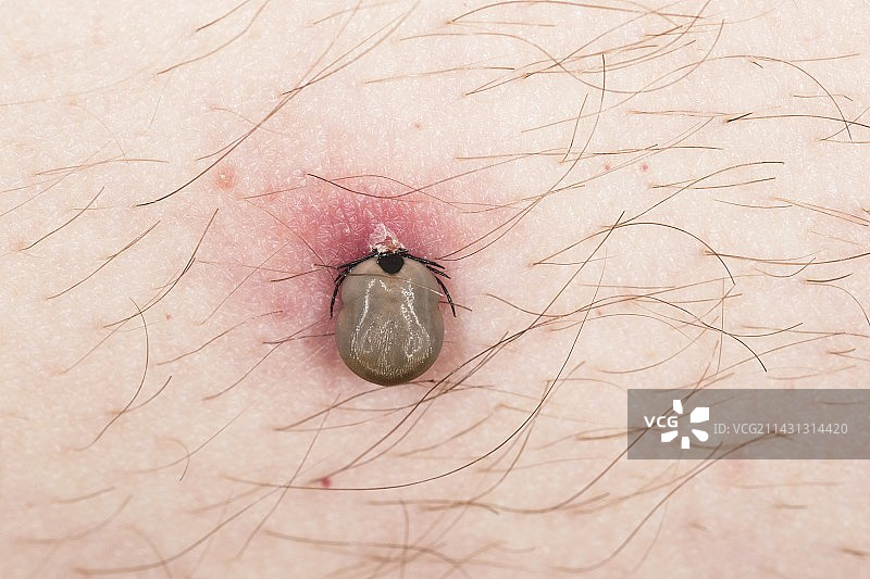 蜱虫叮咬男人图片素材