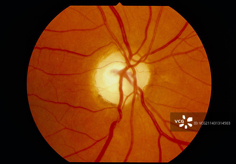 检眼镜下的视网膜和视神经萎缩图片素材