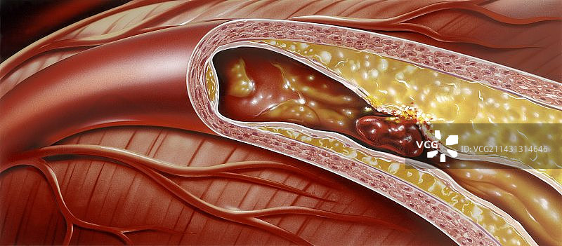 阻塞的冠状动脉，艺术作品图片素材