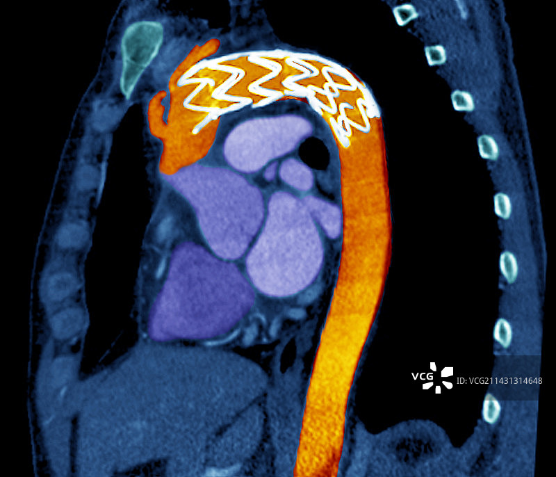 CT扫描：主动脉夹层中的支架图片素材