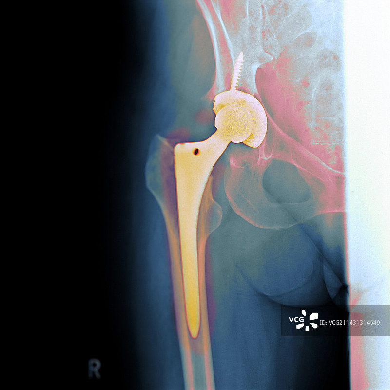 全髋关节置换X光片图片素材