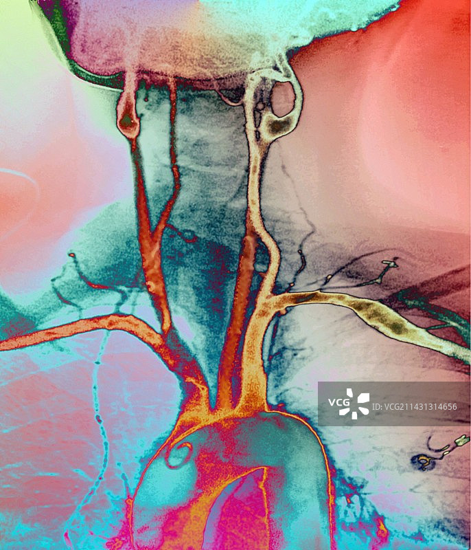 胸部和颈部动脉X光片图片素材