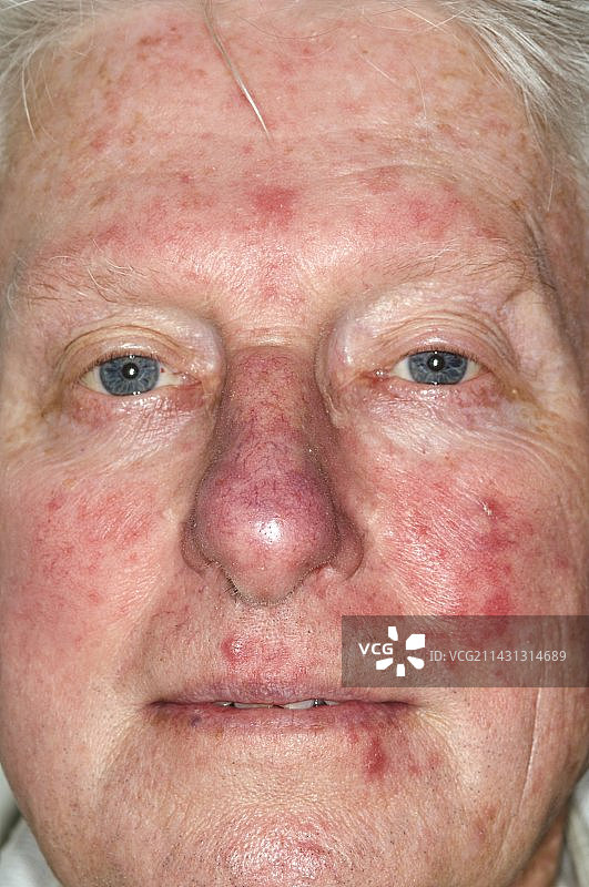 面部玫瑰痤疮图片素材