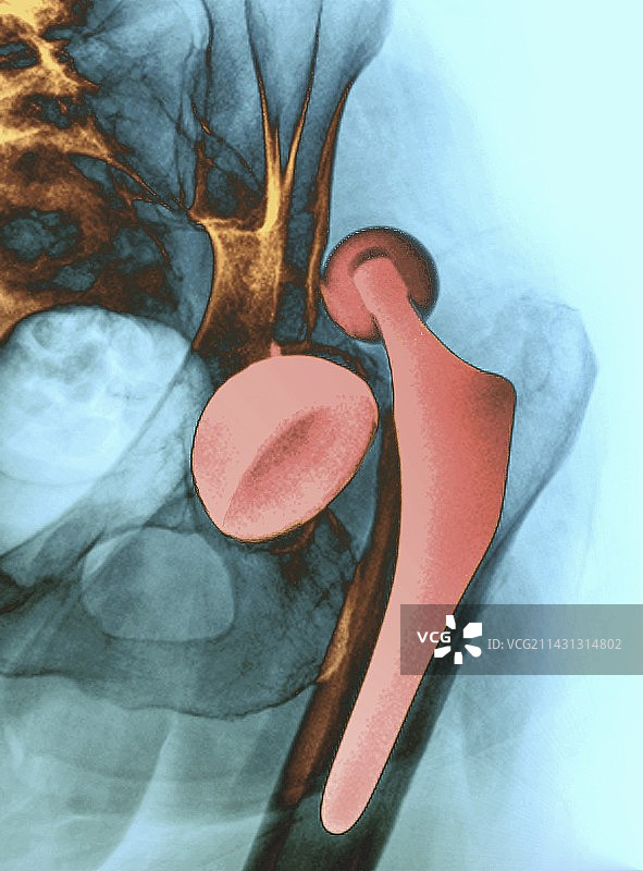 髋关节置换脱位X光片图片素材