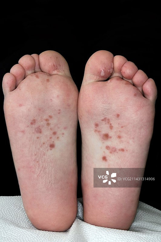手足口病图片素材