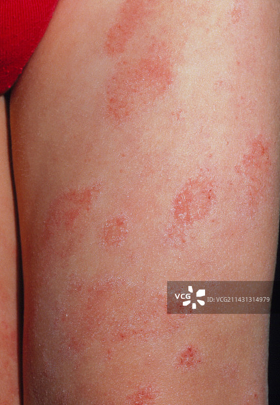 儿童腿部湿疹图片素材