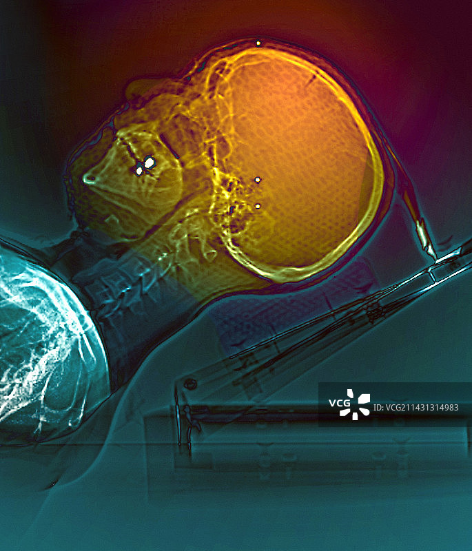 脑癌放射治疗，CT扫描图片素材