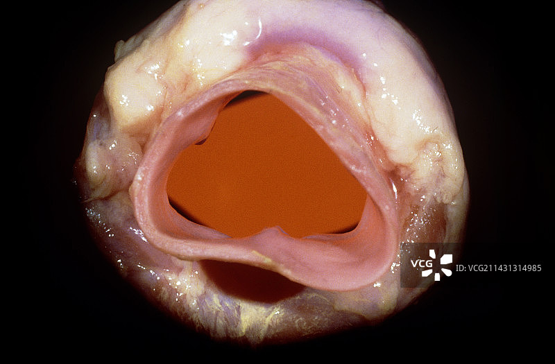 开放的肺动脉瓣照片图片素材