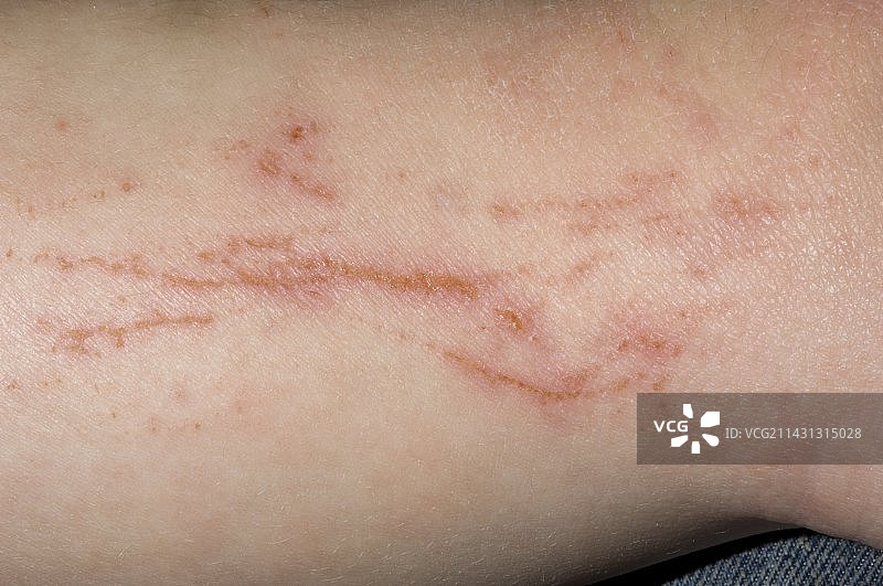 带有抓痕的特应性湿疹图片素材