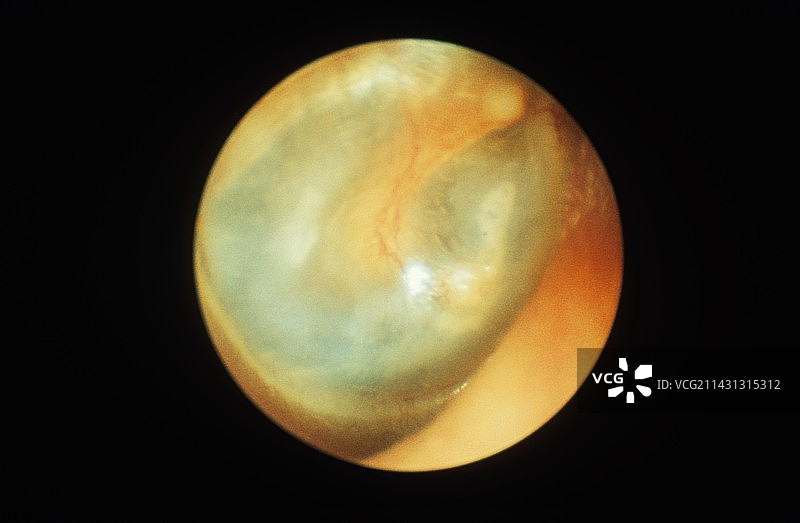 耳膜的耳镜观察图图片素材