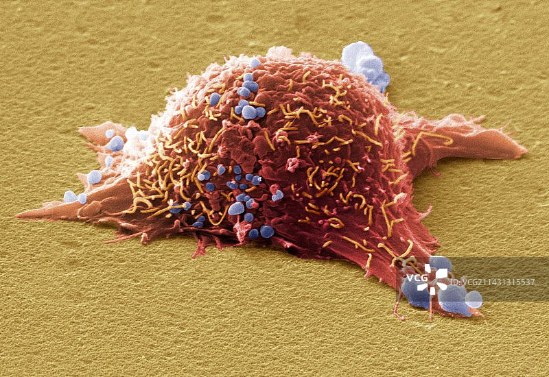 皮肤癌细胞，扫描电子显微镜图片素材
