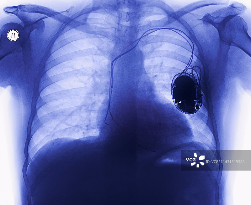 心脏起搏器X光片图片素材