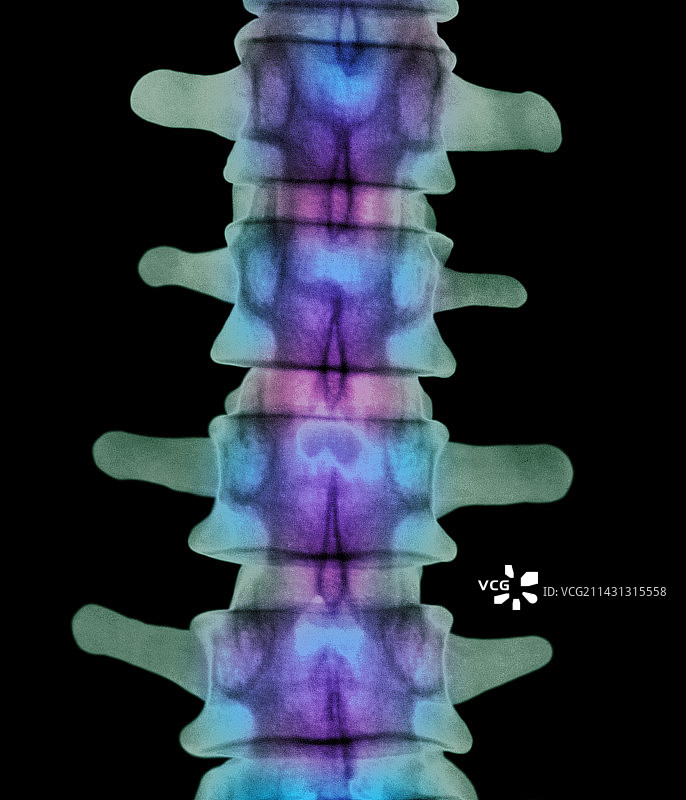 腰椎的彩色X光片图片素材