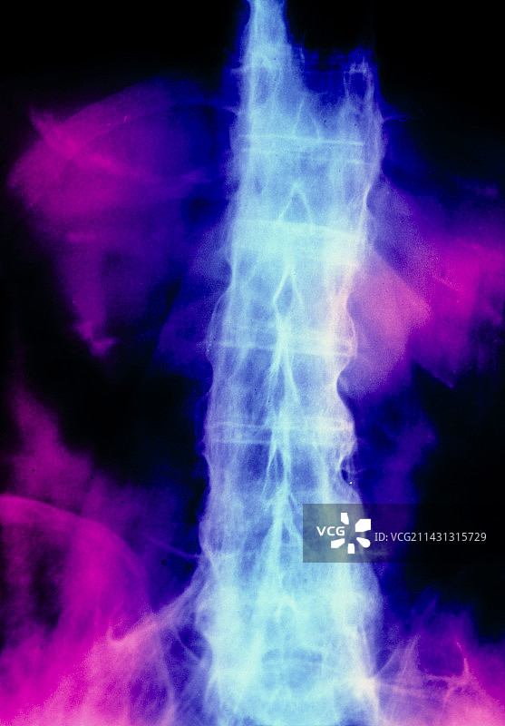 脊柱X光片：强直性脊柱炎图片素材
