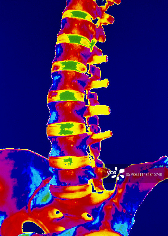 下脊柱彩色三维CT扫描图片素材