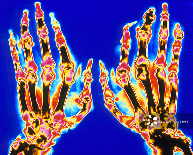 痛风性关节炎手部彩色X光片图片素材