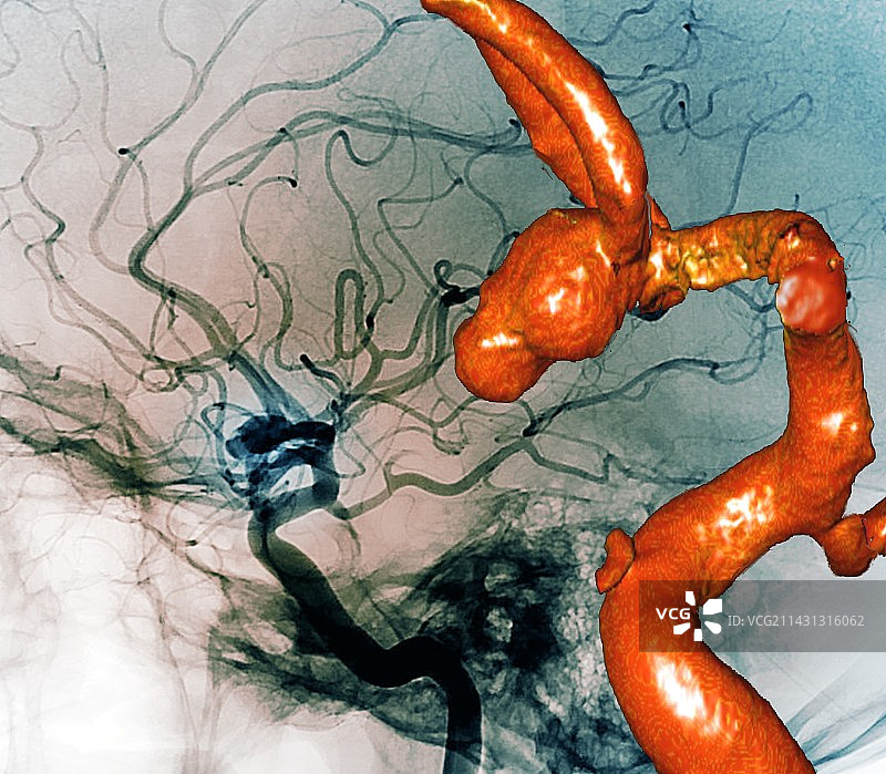 脑动脉瘤2D和3D血管造影图片素材