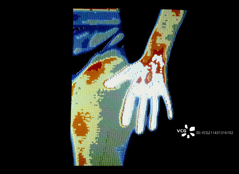 显示手部类风湿性关节炎的热成像图图片素材