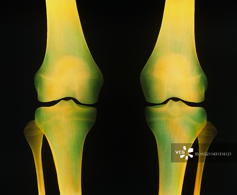 健康膝关节（双腿）的彩色X光片图片素材