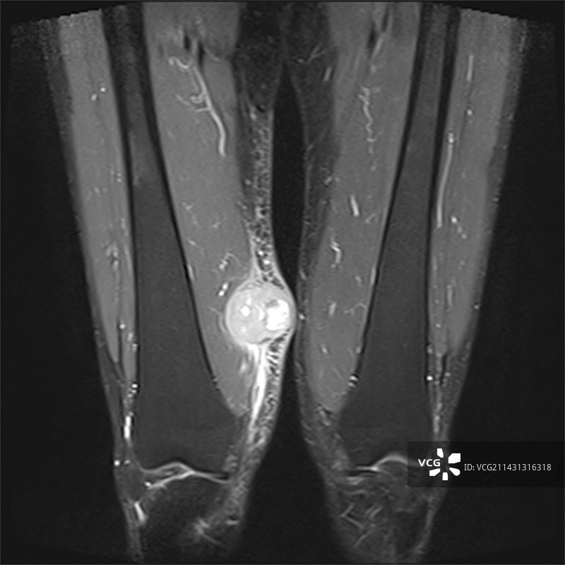 恶性肿瘤（肉瘤）MRI图片素材