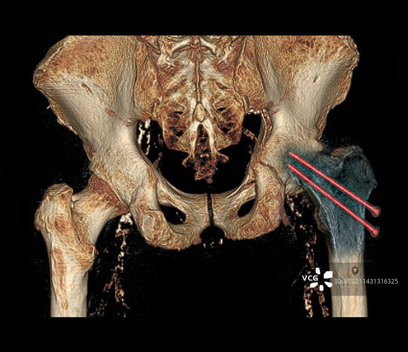髋部骨折复位3D CT扫描图片素材