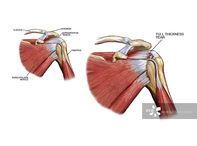 肩袖肌腱损伤图片素材