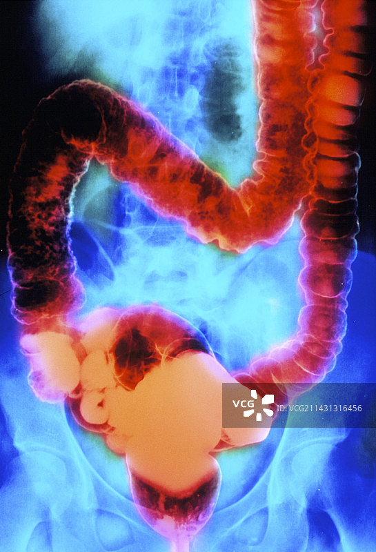 溃疡性结肠炎双重对比X射线图片素材