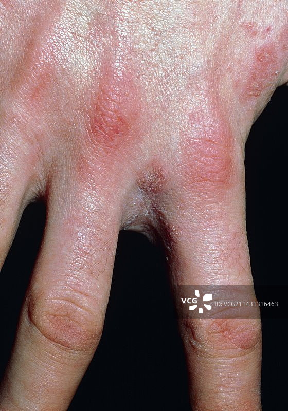 手和手指上的疥疮感染图片素材