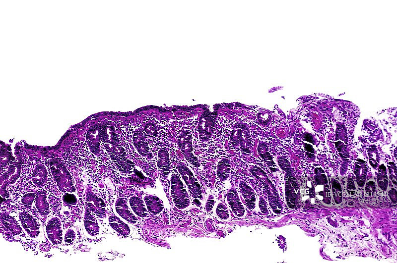 腹腔疾病显微照片图片素材
