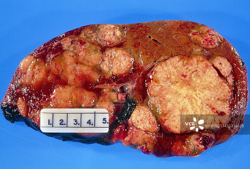 受转移性癌影响的肝脏图片素材