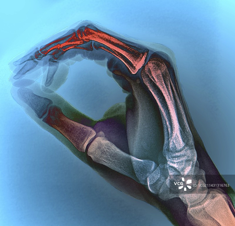 书写姿势的手部X光片图片素材