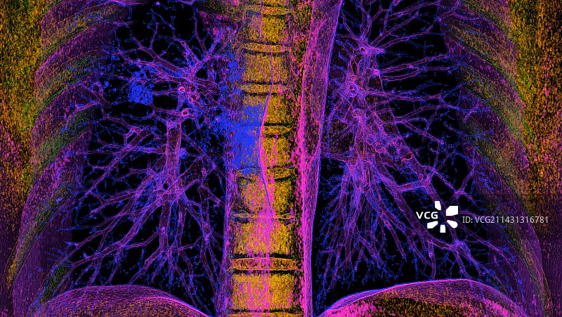 新冠肺炎感染肺部CT扫描图片素材