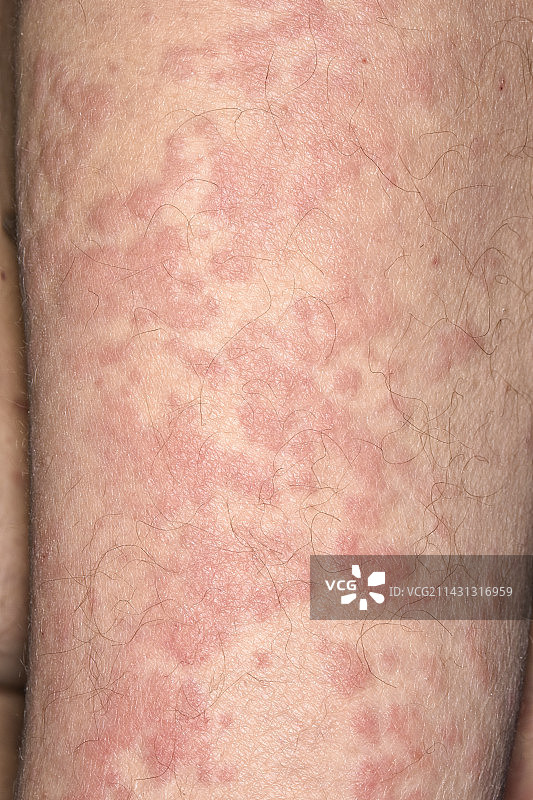 荨麻疹图片素材