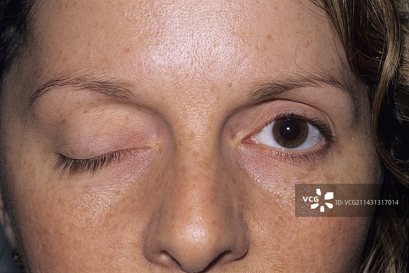 动眼神经麻痹图片素材