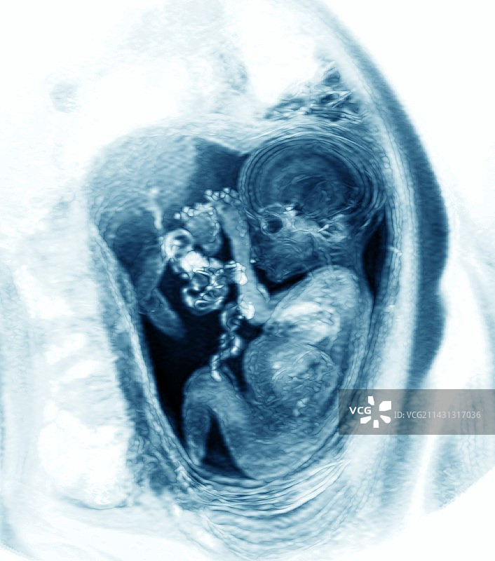 9个月胎儿核磁共振扫描图片素材