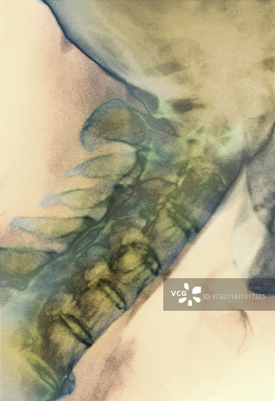 颈部骨刺X光片图片素材