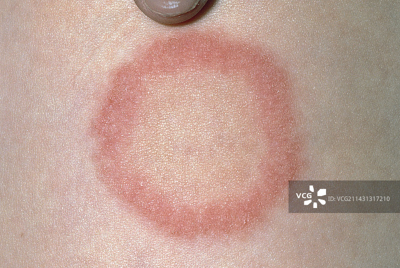 女孩腿上 Ringworm 感染的特写图片素材