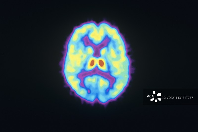 阿片受体PET扫描图片素材