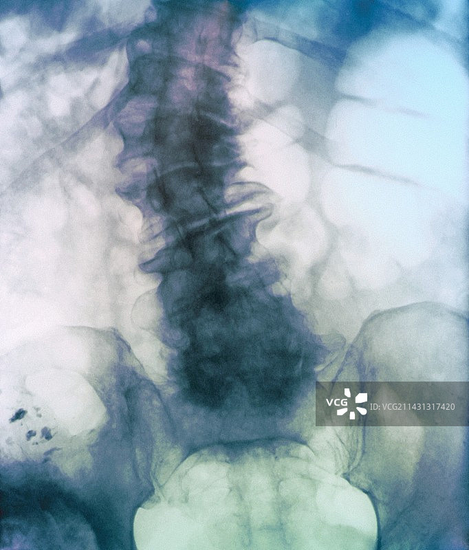 病变脊柱图片素材
